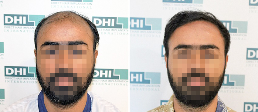 DHI before & after hair transplant results